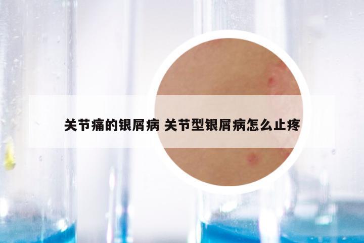 关节痛的银屑病 关节型银屑病怎么止疼