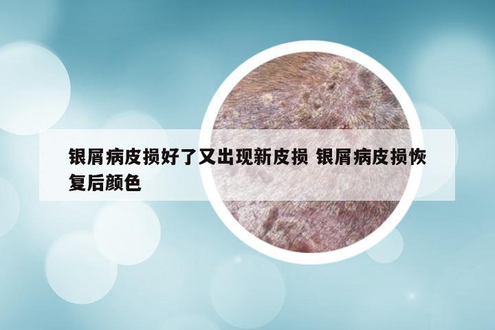 银屑病皮损好了又出现新皮损 银屑病皮损恢复后颜色