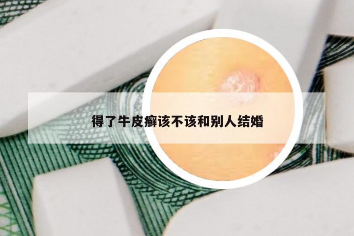 得了牛皮癣该不该和别人结婚