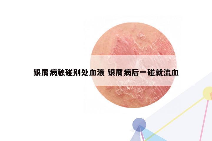 银屑病触碰别处血液 银屑病后一碰就流血