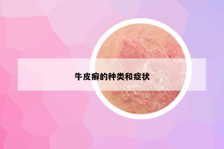 牛皮癣的种类和症状