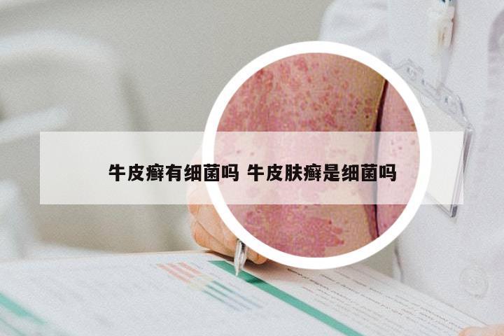 牛皮癣有细菌吗 牛皮肤癣是细菌吗