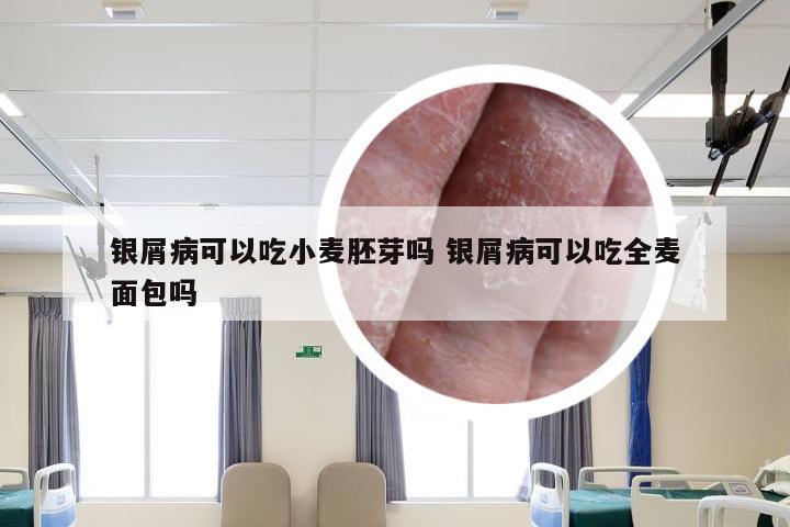银屑病可以吃小麦胚芽吗 银屑病可以吃全麦面包吗