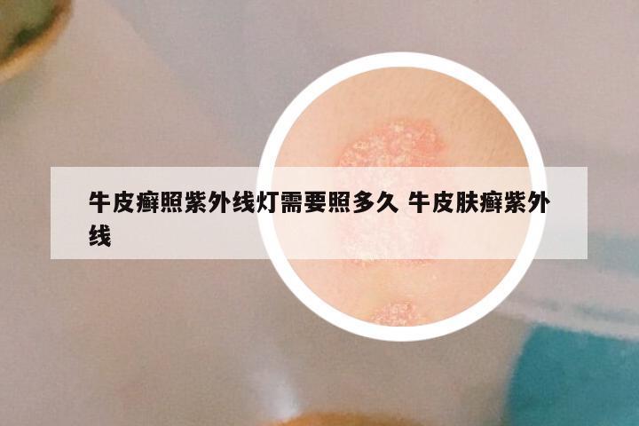 牛皮癣照紫外线灯需要照多久 牛皮肤癣紫外线