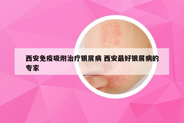 西安免疫吸附治疗银屑病 西安最好银屑病的专家