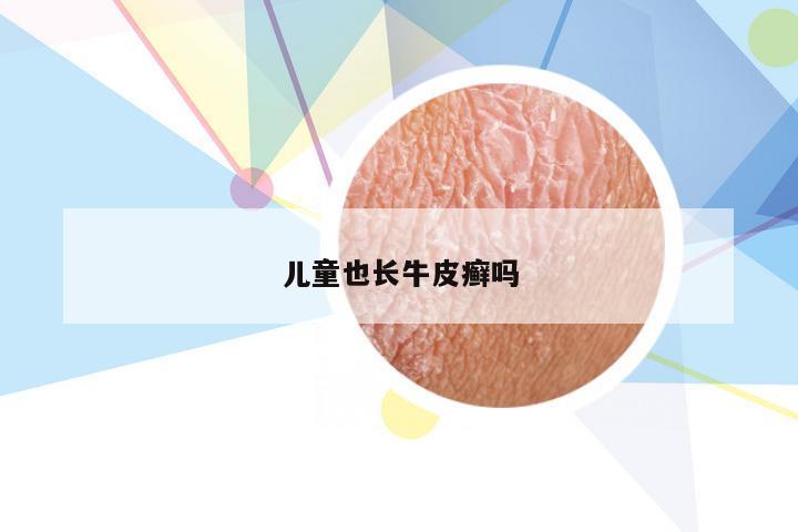 儿童也长牛皮癣吗