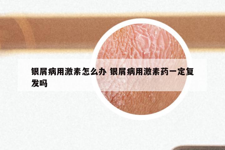银屑病用激素怎么办 银屑病用激素药一定复发吗