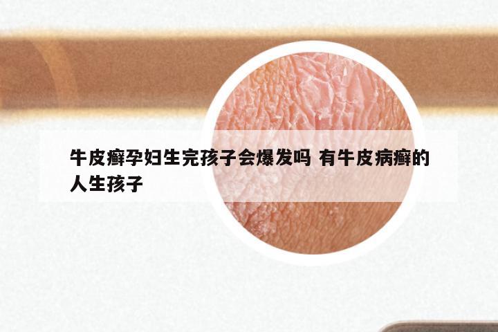 牛皮癣孕妇生完孩子会爆发吗 有牛皮病癣的人生孩子