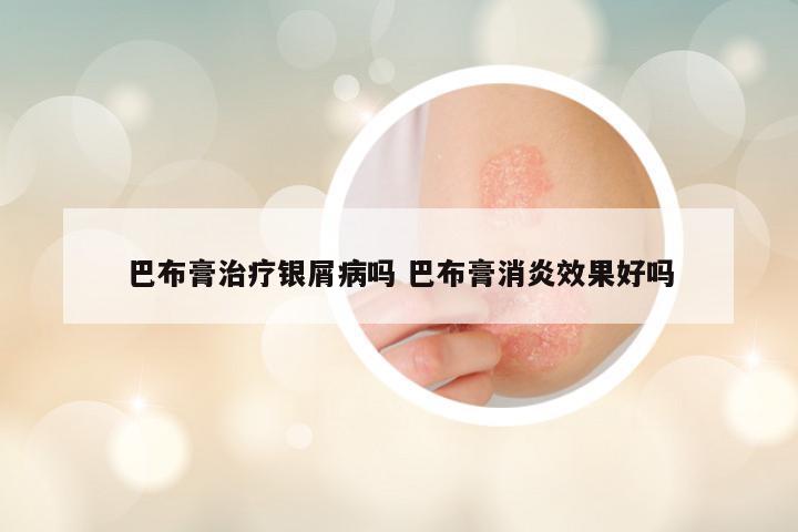 巴布膏治疗银屑病吗 巴布膏消炎效果好吗