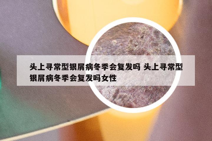 头上寻常型银屑病冬季会复发吗 头上寻常型银屑病冬季会复发吗女性
