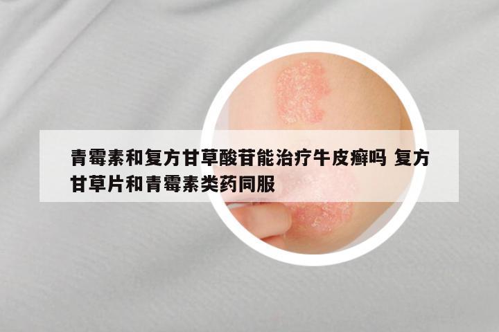 青霉素和复方甘草酸苷能治疗牛皮癣吗 复方甘草片和青霉素类药同服