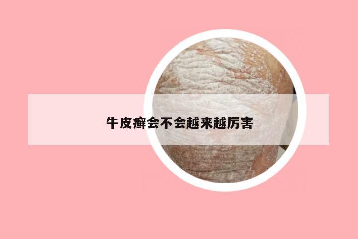 牛皮癣会不会越来越厉害