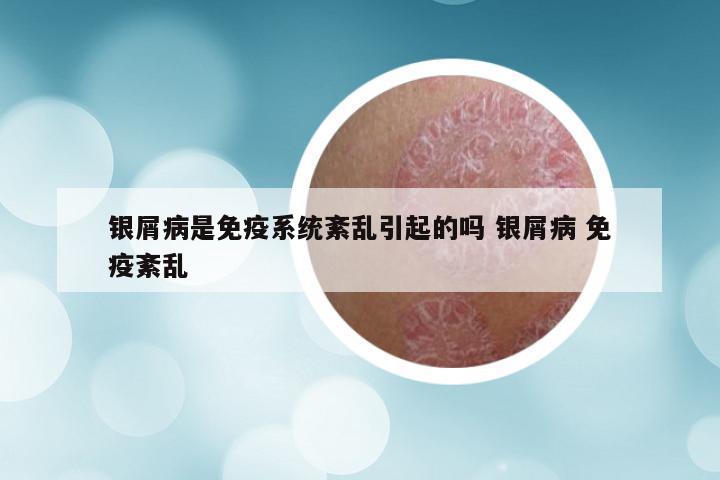 银屑病是免疫系统紊乱引起的吗 银屑病 免疫紊乱