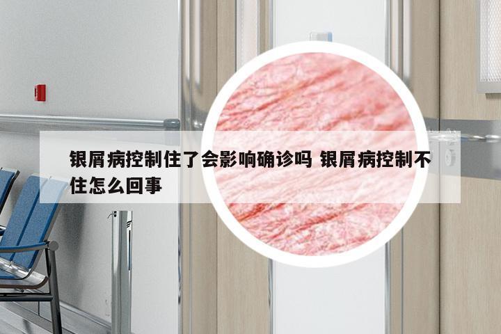 银屑病控制住了会影响确诊吗 银屑病控制不住怎么回事