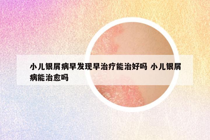 小儿银屑病早发现早治疗能治好吗 小儿银屑病能治愈吗