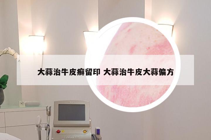 大蒜治牛皮癣留印 大蒜治牛皮大蒜偏方