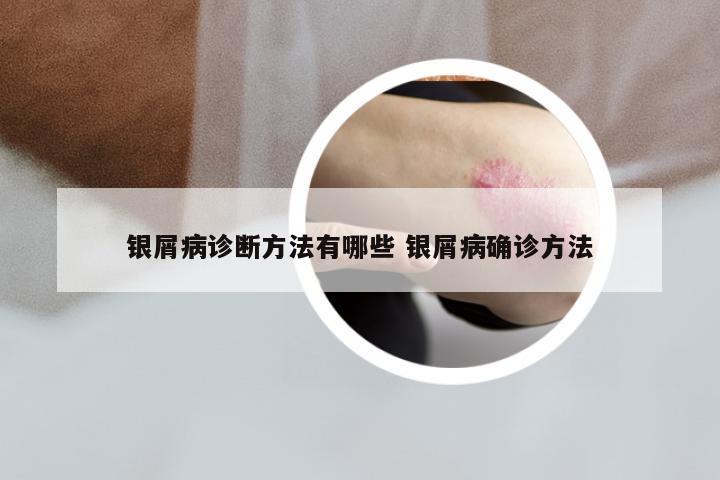 银屑病诊断方法有哪些 银屑病确诊方法