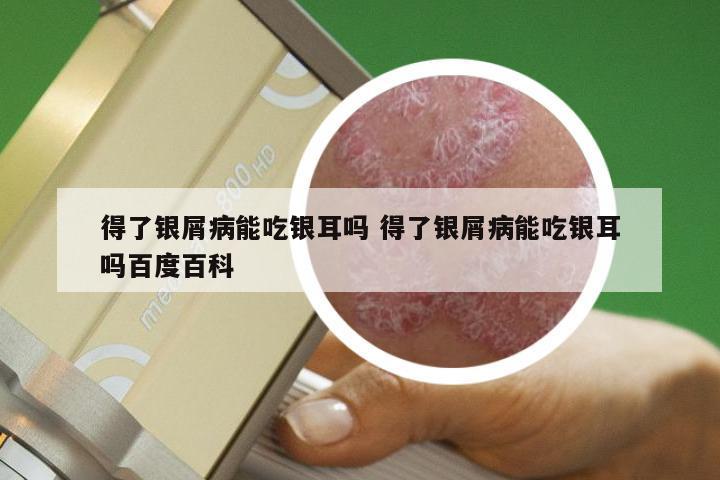 得了银屑病能吃银耳吗 得了银屑病能吃银耳吗百度百科