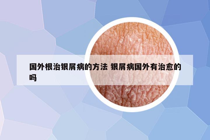 国外根治银屑病的方法 银屑病国外有治愈的吗