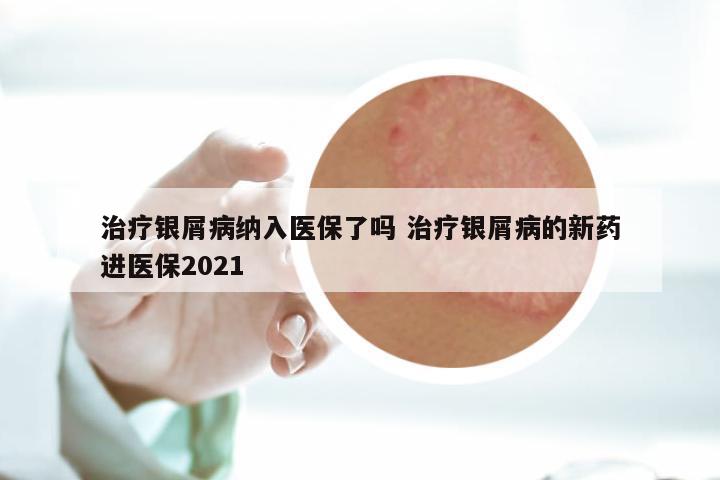 治疗银屑病纳入医保了吗 治疗银屑病的新药进医保2021