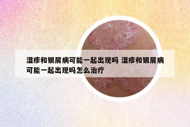 湿疹和银屑病可能一起出现吗 湿疹和银屑病可能一起出现吗怎么治疗