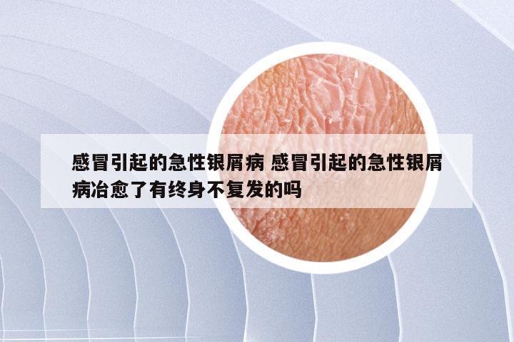 感冒引起的急性银屑病 感冒引起的急性银屑病冶愈了有终身不复发的吗