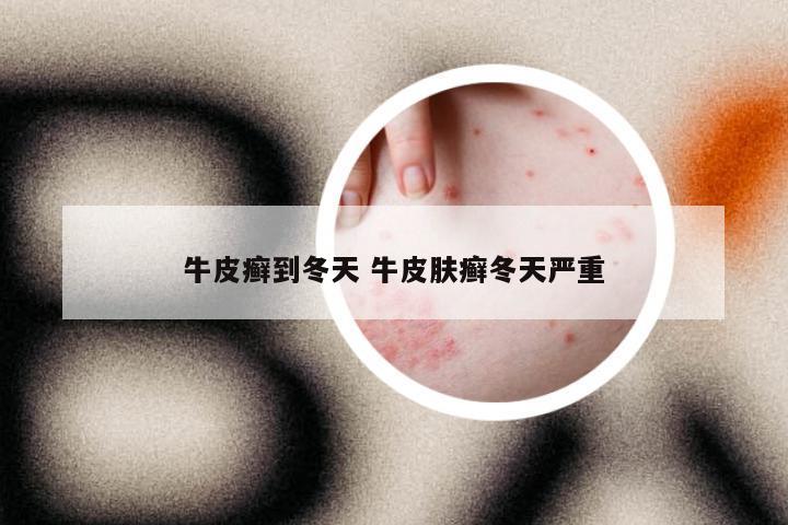 牛皮癣到冬天 牛皮肤癣冬天严重