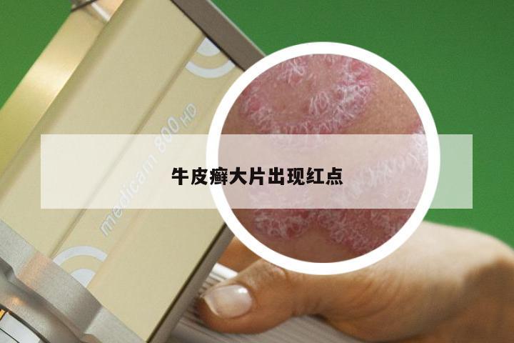 牛皮癣大片出现红点
