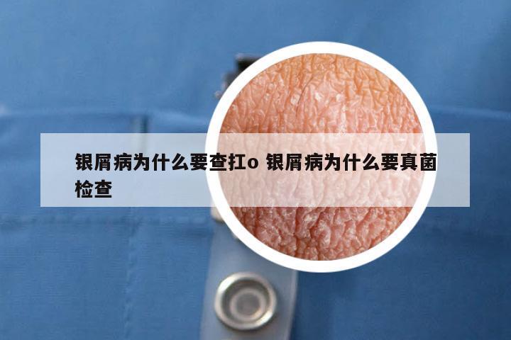 银屑病为什么要查扛o 银屑病为什么要真菌检查