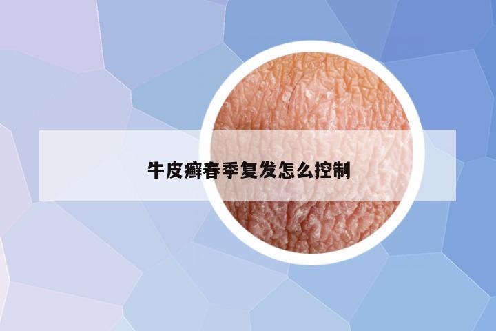 牛皮癣春季复发怎么控制