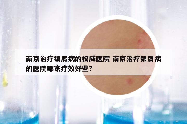 南京治疗银屑病的权威医院 南京治疗银屑病的医院哪家疗效好些?