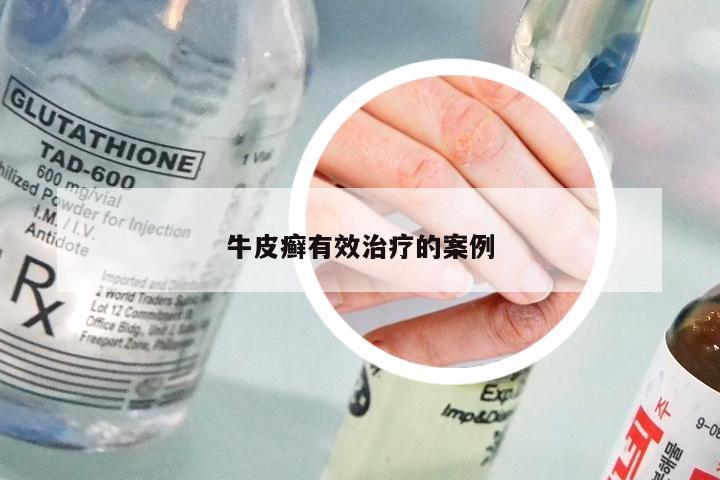牛皮癣有效治疗的案例