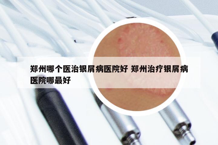 郑州哪个医治银屑病医院好 郑州治疗银屑病医院哪最好