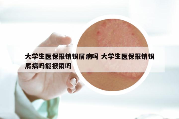 大学生医保报销银屑病吗 大学生医保报销银屑病吗能报销吗