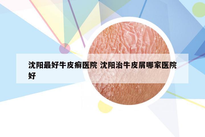 沈阳最好牛皮癣医院 沈阳治牛皮屑哪家医院好