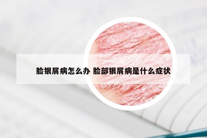 脸银屑病怎么办 脸部银屑病是什么症状