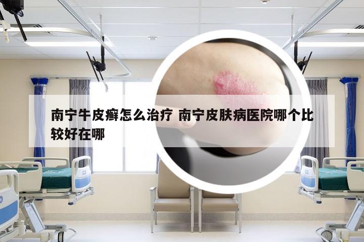 南宁牛皮癣怎么治疗 南宁皮肤病医院哪个比较好在哪