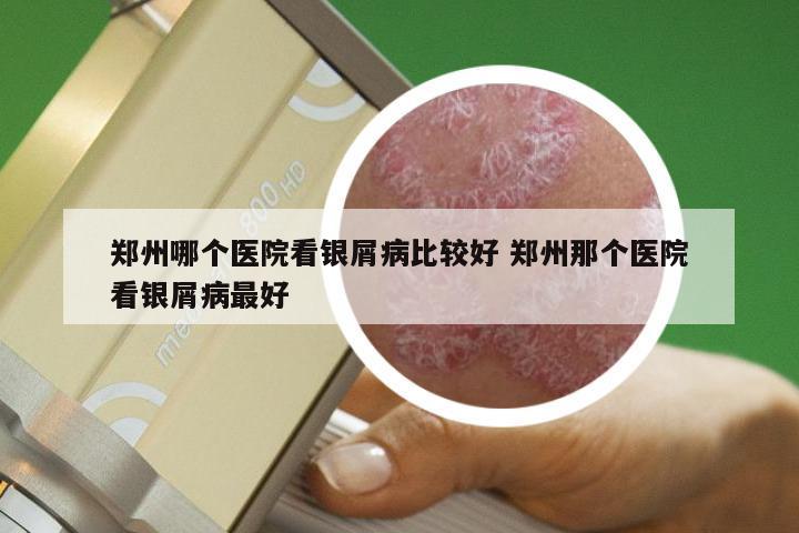 郑州哪个医院看银屑病比较好 郑州那个医院看银屑病最好