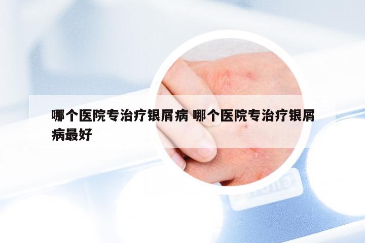 哪个医院专治疗银屑病 哪个医院专治疗银屑病最好