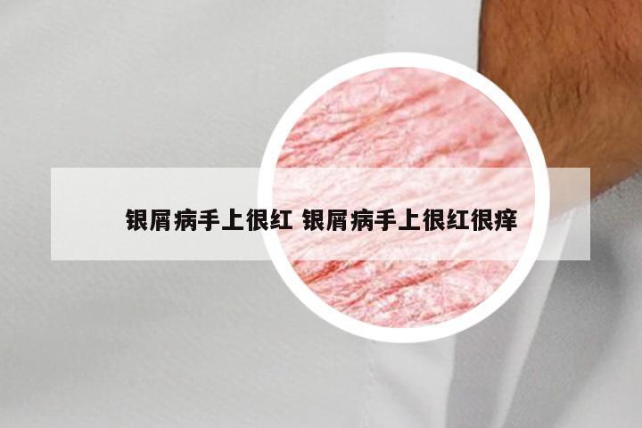 银屑病手上很红 银屑病手上很红很痒