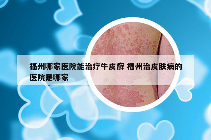 福州哪家医院能治疗牛皮癣 福州治皮肤病的医院是哪家