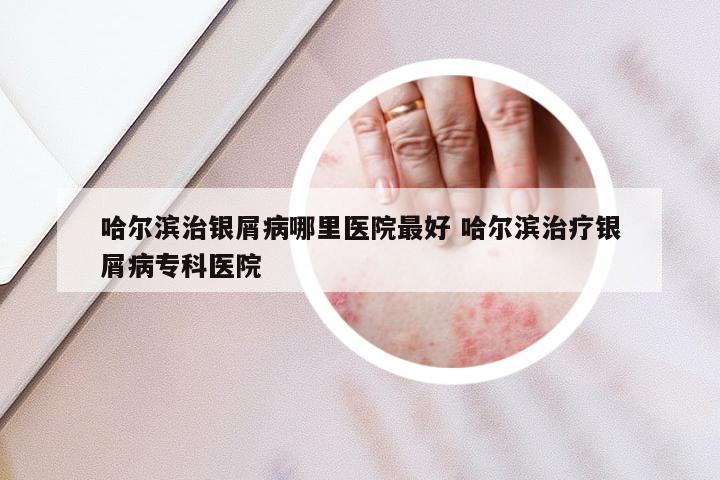 哈尔滨治银屑病哪里医院最好 哈尔滨治疗银屑病专科医院