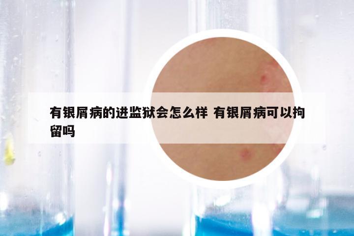 有银屑病的进监狱会怎么样 有银屑病可以拘留吗