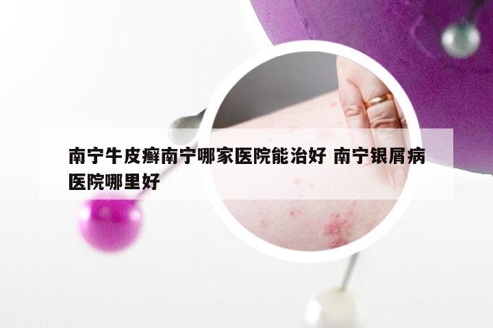 南宁牛皮癣南宁哪家医院能治好 南宁银屑病医院哪里好