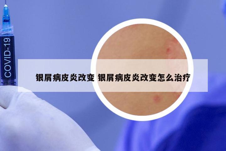 银屑病皮炎改变 银屑病皮炎改变怎么治疗