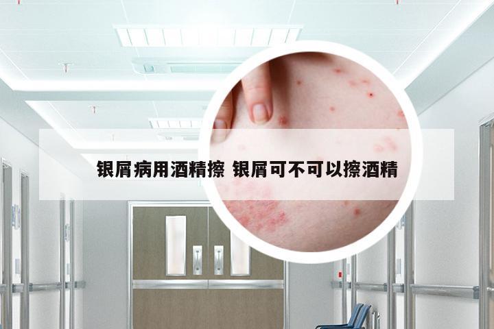 银屑病用酒精擦 银屑可不可以擦酒精