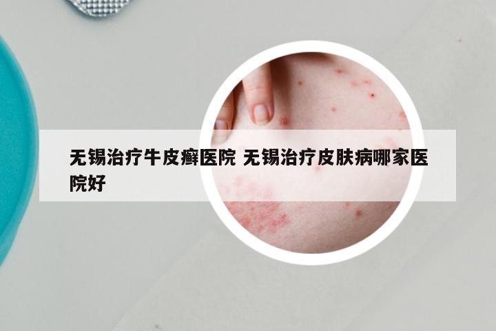 无锡治疗牛皮癣医院 无锡治疗皮肤病哪家医院好