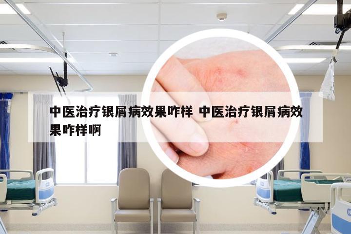 中医治疗银屑病效果咋样 中医治疗银屑病效果咋样啊