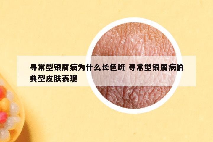 寻常型银屑病为什么长色斑 寻常型银屑病的典型皮肤表现