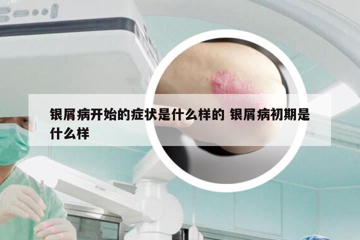 银屑病开始的症状是什么样的 银屑病初期是什么样